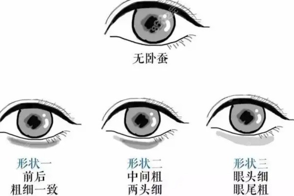 及云澤埋線雙眼皮總結(jié)與建議