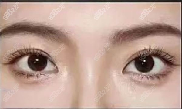 李燕醫(yī)生的雙眼皮手術(shù)技術(shù)實(shí)力強(qiáng)