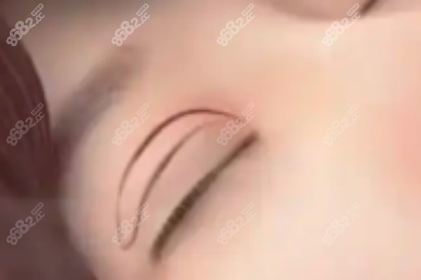 及云澤做埋線雙眼皮怎么樣