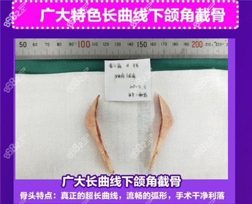 廣州廣大醫(yī)院下頜角截骨手術(shù)