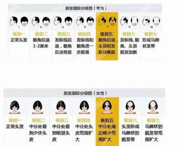 脱发等级划分