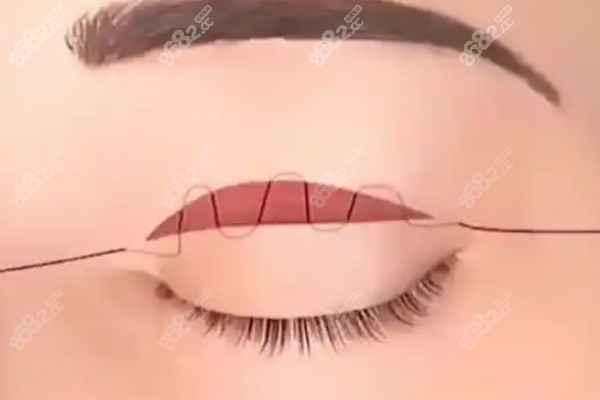 a08537cd56b767e80ae3fd4490ebd96.jpg 及云澤做埋線雙眼皮在沈陽(yáng)杏林