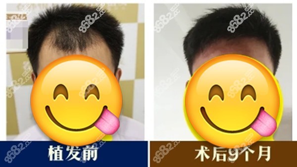 济南名韩植发对比照