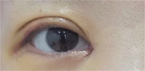 自体脂肪眼窝填充后多久恢复好，多久能纹美瞳线？一文详