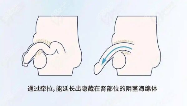 变性手术费用是多少