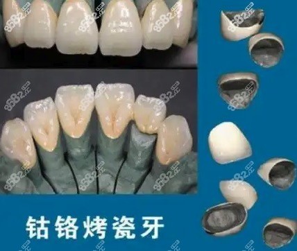 上海钴铬烤瓷牙收费贵吗