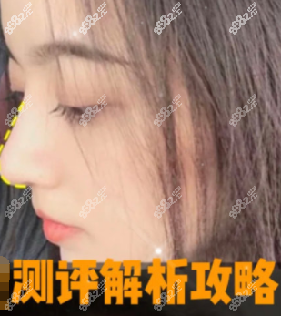 上海隆鼻測(cè)評(píng) 上海隆鼻測(cè)評(píng)