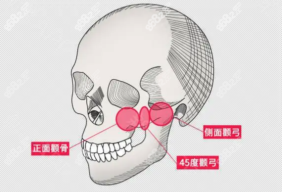 潘宝华颧骨整形技术先进