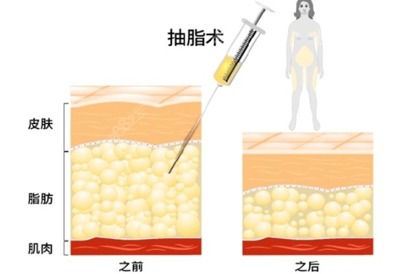 北京脂肪填充王东和王明利谁更牛