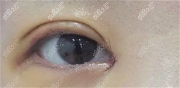 自體脂肪眼窩填充后多久可以紋美瞳線