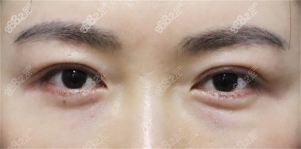 穩(wěn)定期（術(shù)后 1 - 3 個月）