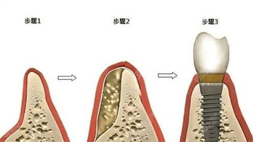 曲靖諾貝爾口腔醫(yī)院種植牙技術(shù)