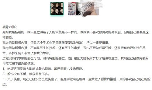 朱石江颧骨颧弓手术做得怎样