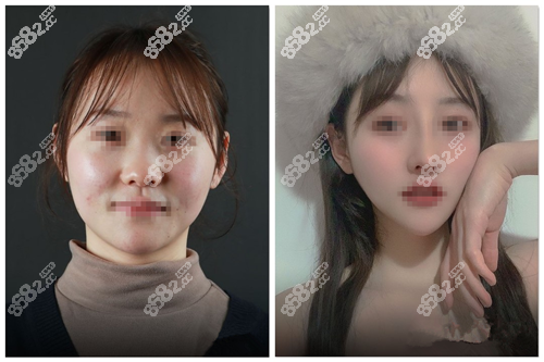 <!--<i data=20240705-sp></i>-->鼻综合手术<span style=