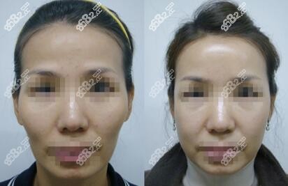 李承灿做全脸颊缩小前后对比图