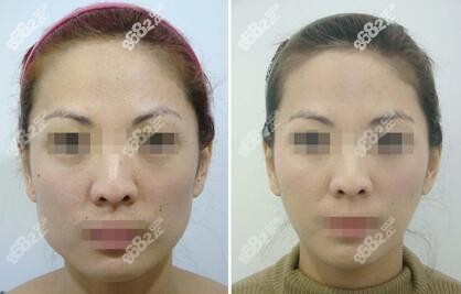 下颌骨宽大缩小真人前后对比图