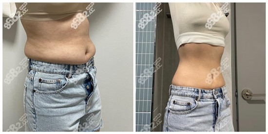 韩国365mc腰腹部吸脂手术实拍对比图