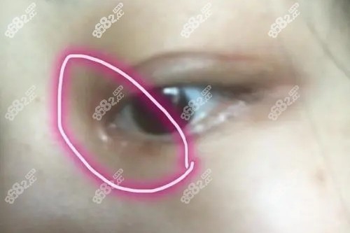 开眼角后留疤怎么办