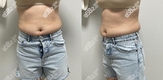 韩国365mc腹部吸脂术前实拍