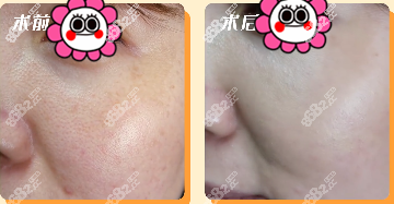 光子嫩肤效果好吗？激光美容科刘滢医生光子嫩肤案例效果参考