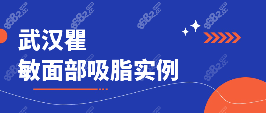 武漢瞿敏面部吸脂實例