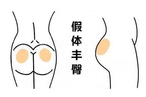 深圳福雅何奇醫(yī)生假體豐臀術(shù)后評(píng)價(jià)