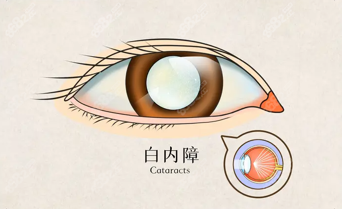 南二院眼科患者范例：从恐惧到光明的心路历程