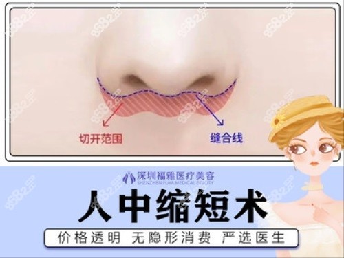 深圳福雅何奇醫(yī)生人中縮短術(shù)