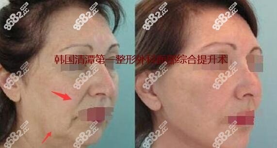 成镇模面部拉皮手术实例对比图8682.cc