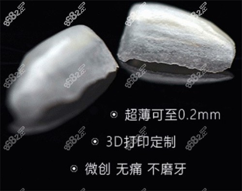 美加超薄瓷贴面的优势