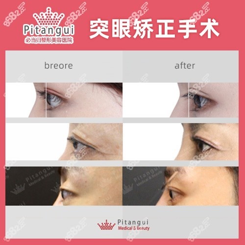 韩国必当归医院柳济圣突眼矫正手术真人案例
