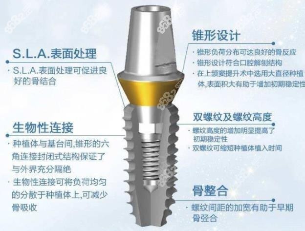 登腾植体优势