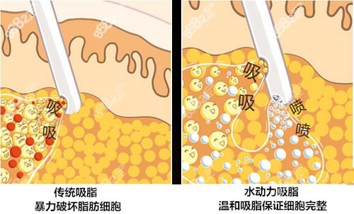 负压吸脂和水动力吸脂的区别