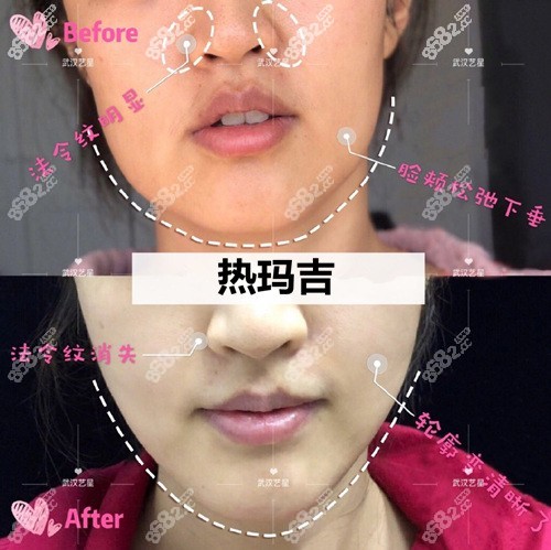 武汉做一次热玛吉要多少钱