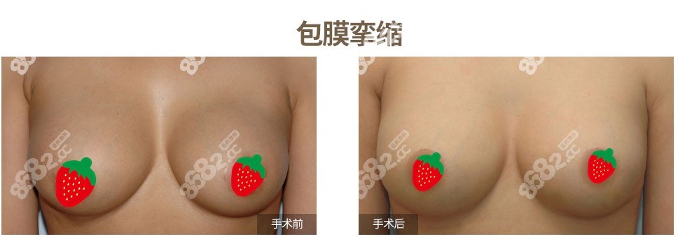 韩国MD李相达院长做包膜挛缩胸修复实例m.8682.cc