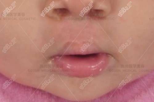 廣州出名的唇腭裂醫(yī)生是余文林