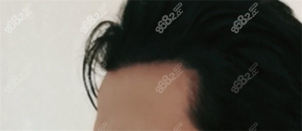 种植美人尖成效能保持多久