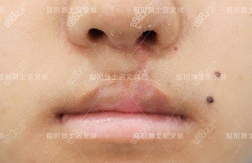 廣州出名的唇腭裂醫(yī)生是余文林