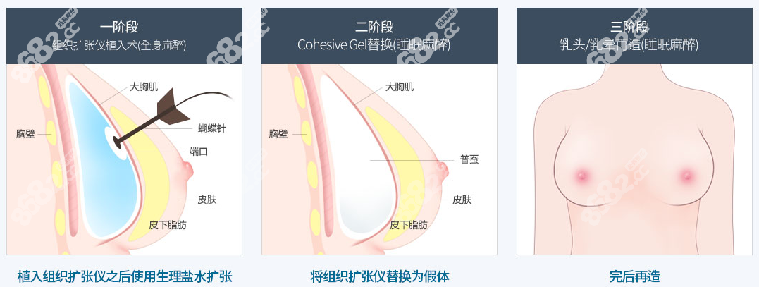 假体植入胸再造手术方法