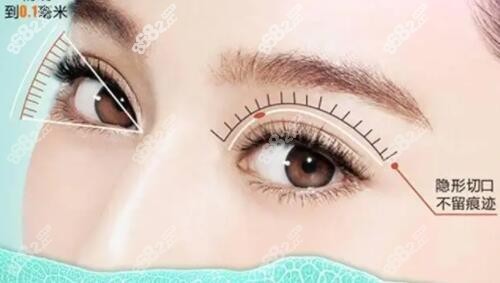 沈阳美莱割双眼皮