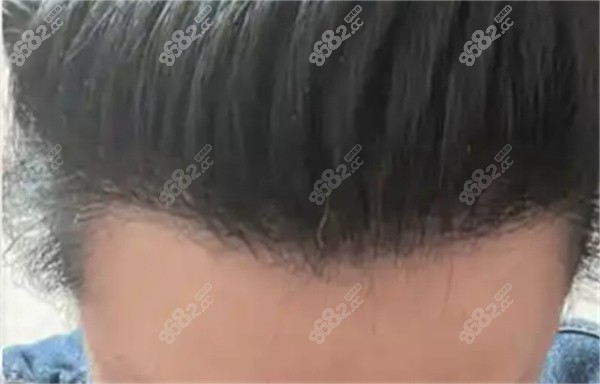 美人尖种植手术的能保持多久