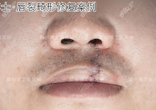 广州出名的唇腭裂医生是余文林，修复兔唇技术好成效自然