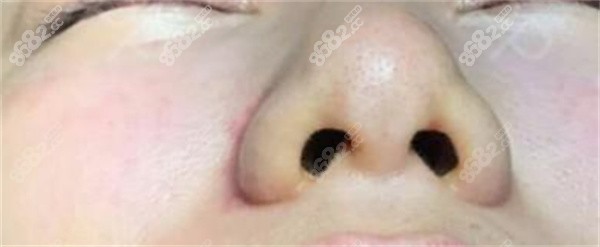 玻尿酸填充可以缩小鼻头抬高鼻小柱吗