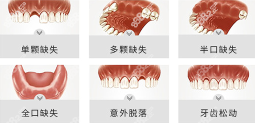 重庆种植牙好的医院汇总