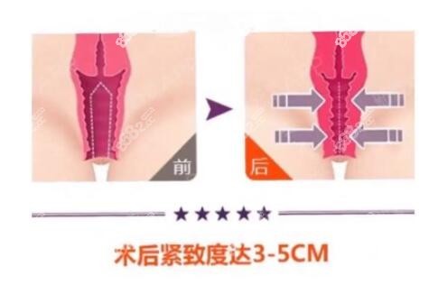 手术紧缩私密的疗效