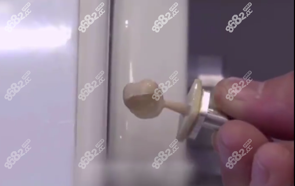 做一颗德国vita全瓷牙