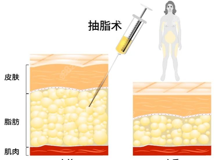 深圳万晓楠3S人鱼体雕技术解析