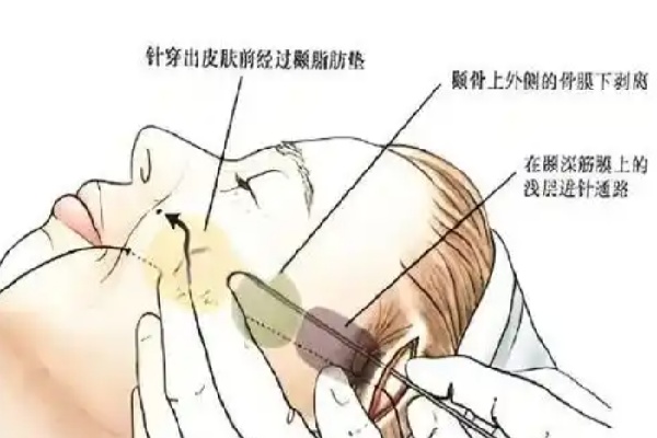不开刀降颧骨创办者王东怎么样,网传北京明星御高口碑医生