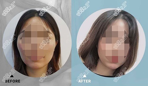 整形医院颧骨整形对比照片