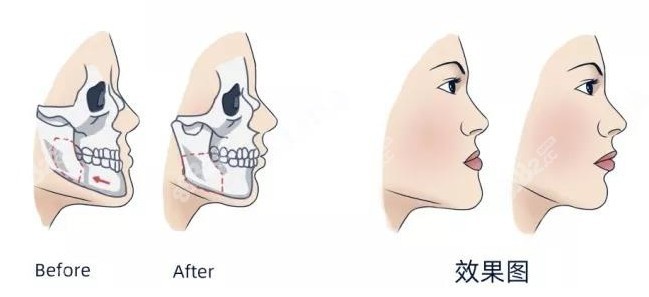 正颌手术前后对比结果图